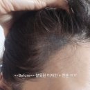 (인천 청라) 인천두피문신 더이녹스칼프 헤어라인 내돈내산 후기