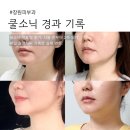 미소의원 | 쿨소닉리프팅 2주 후기｜친절한미소의원 매일 사진 경과 기록