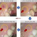 입천장 뾰루지에 혀를 대면 아픈데, 발치해야 된대요 feat. 재신경치료 후기