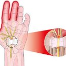 손목터널증후군 확인 효능 및 증상 원인 이미지