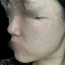 루비커텐 | 루비레이저 후기: 압구정 루나의원