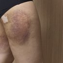 수원 허벅지 지방추출주사 2주 후 멍 통증 라인 체중변화 효과는 얼마나 보일까?