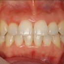 백석미소담은치과의원 | 교정치료를 고민하신다면, 시행착오를 줄여 교정치료를 마무리하는 미소담은치과의 교정 원칙(송촌동 교정)