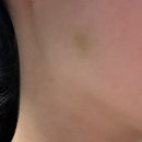 연세라미슈의원 | 연세 라미슈 의원-사각턱 보톡스 후기