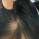 국홍일국정표피부과의원 | 여자 스트레스성 원형탈모 치료기 / 양재 국홍일국정표 피부과