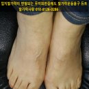 무지외반증 소건막류 발가락변형엔 발가락운동용구 듀트 이미지