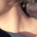 아산플러스가정의학과의원 | 경산 효성의원 주근깨, 편평성 사마귀, 쥐젖 제거 비용 및 오픈런 후기(대구 동구 SSG가정의학과와 비교)