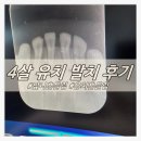 유치 흔들림 앞니 빠짐 4살 유치 발치 후기