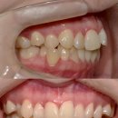 의정부연세이예쁜치과교정과치과의원 | 의정부역 치과 : 입술과 얼굴형을 고려한 맞춤 교정 - ‘작고 얇은 입술’