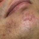 좋은일자리연구소 | 여드름관리 맛집 &#39;뷰티건강연구소 강남 신사본점&#39; 신사 가로수길 피부관리 압출 잘하는곳!