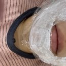 멍마실 | 서면 인모드 후기 15분 투자로 이중턱 정리 과정 | 멍 부작용