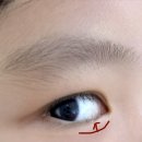 눈비체안경 | 7살 여아 대전건양대 유아 안검내반 수술 후기