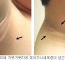 뚱뚱해지면서 목뒤가 거뭇거뭇 … ‘흑색가시세포증’이라고? 이미지