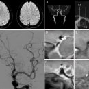 사본/ 고해상도-자기공명영상으로 확진한, 내경동맥 박리를 동반한 자발성 중대뇌동맥박리 1예 이미지