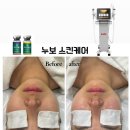 누보스킨