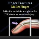 Mallet Finger Fracture 이미지