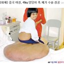 45kg 엉덩이 혹 제거한 중국 여인 이미지