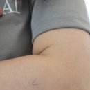 삼천포정형외과의원 | 진주 하얀메디컬 지방종 제거수술(수술 및 입원후기)