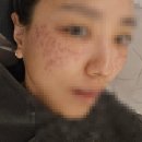 관악우태하피부과의원 | 내돈내산 루비레이저 후기 가격 부작용 딱지 점선면의원 추천