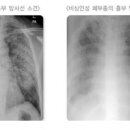 폐에 물이 차면 나타나는 증상과 치료 물이차는 이유 : 폐물참 의심 질환(폐부종 폐수종) 이미지