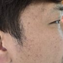 부천 모낭염치료 현대백화점9층 리더스피부과 내돈내산후기