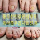 연세요양병원 | 육아종?”·포천.동두천·양주·의정부 여성 환자의 감춰진 발 통증 동두천 한강연세병원 치료 후기