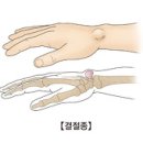 결절종 (Ganglion) 이미지