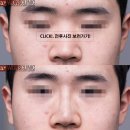 오투성형외과의원 | 수원하이코 코필러 전후사진 보러가기 2025_03_15 인계동 원스의원