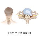 경추 추간판 탈출증(Cervical HIVD) 이미지