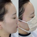 그린라인 전주전북센터 | 전주헤어라인왁싱으로 좁은 이마 라인 깔끔하게 교정한후기