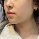 연남동피부관리 추천｜홍대뷰티클럽 V라인 관리 후기, 붓기 달라짐