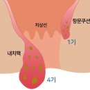 치센 치질약 부작용 걱정보다 바로 수술하는게 답이였어요 [부평 유앤항외과]