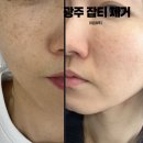 뷰티,하나하 | 광주 북구 기미 주근깨 케어 2회차 아임뷰티 내돈내산 솔직 후기