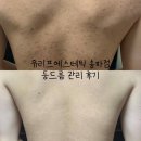 리프에스테틱 | 잠실등드름 관리 받고 피부결까지 달라진 유리프에스테틱 후기