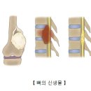 뼈의 신생물[Neoplasm of the bone]근골격질환, 종양혈액질환 이미지