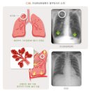 업무[제철소:출선공]와 만성폐쇄성폐질환 사이 상당인과관계를 인정 가능 여부 이미지