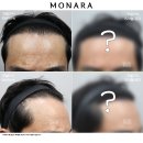 모발이식 후기와 수술 후 주의사항