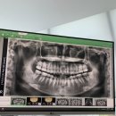 닥터오치과의원 | [창원 치과] 성산구 | 닥터오 치과 | 혼돈의 사랑니 발치 후기 ;0