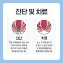 치루개 네이버블로그
