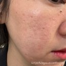 (주)알에프 | 여드름 흉터치료 1회차 시술 후기 (니들알에프 1회차) _ 내돈내산 리뷰
