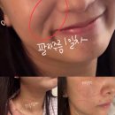 광화로 12-11 ~ 광화로 12-9 사이 | 달바 올쎄라 더블샷 효과 3개월 후기 | 12주의 기적, 생얼 자신감 나만 생기면 안되니까~ 찐 추천