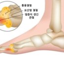 요산이란 이미지