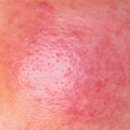 동현한의원 | 주사피부염으로 3년, 레이저만 믿었다가 더 힘들어졌던 솔직 후기