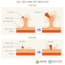 [통합간편]유사암진단 납입지원 특별약관 이미지