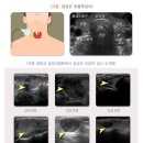 갑상선 검사 이미지