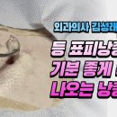 기분 좋게 쏙 나오는 등 피지낭종! 이미지