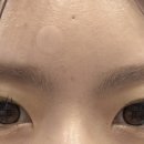 위너메디 | [공지] [수술후기] 위너확장구멍 제거 수술후기 2탄, 수술 1달 후 경과
