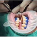 로타리큰약국 | 춘천치아미백, 효과? 부작용? 16년 차 의사가 전부 알려드려요 (가격, 비용)