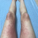 건강 쭉 마음 쭉100세 시대 | [아토피 극복] 중증 아토피 환자의 아토피 극복 일기 (1) 체질개선 프로그램 TR90 시작 💪 내돈내산