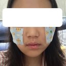 동국목장 | 양악 수술 3~7일차 후기 (퇴원 후 집에서 회복 시작 + 1주 차 병원 방문까지)